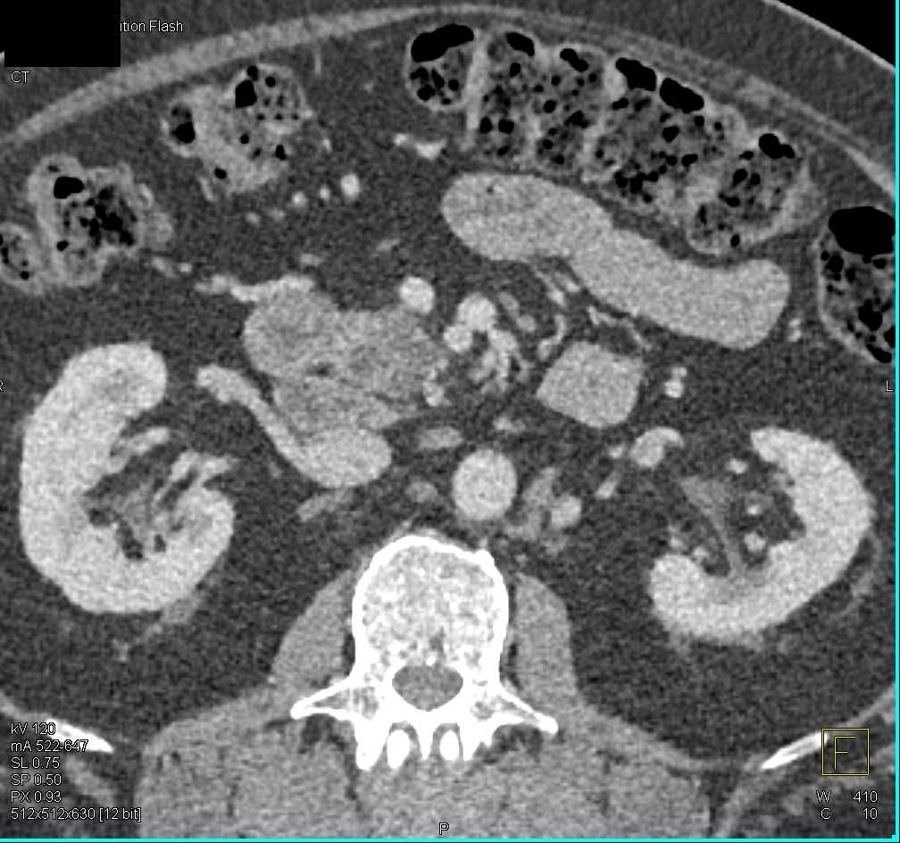 Low Grade IPMN in the Head of the Pancreas - CTisus CT Scan