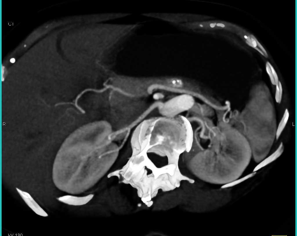 Pancreas Neuroendocrine Tumor - CTisus CT Scan