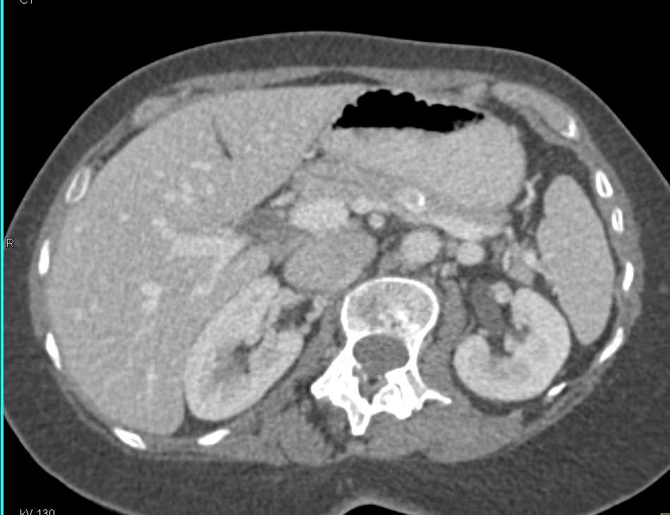 Pancreas Neuroendocrine Tumor - CTisus CT Scan
