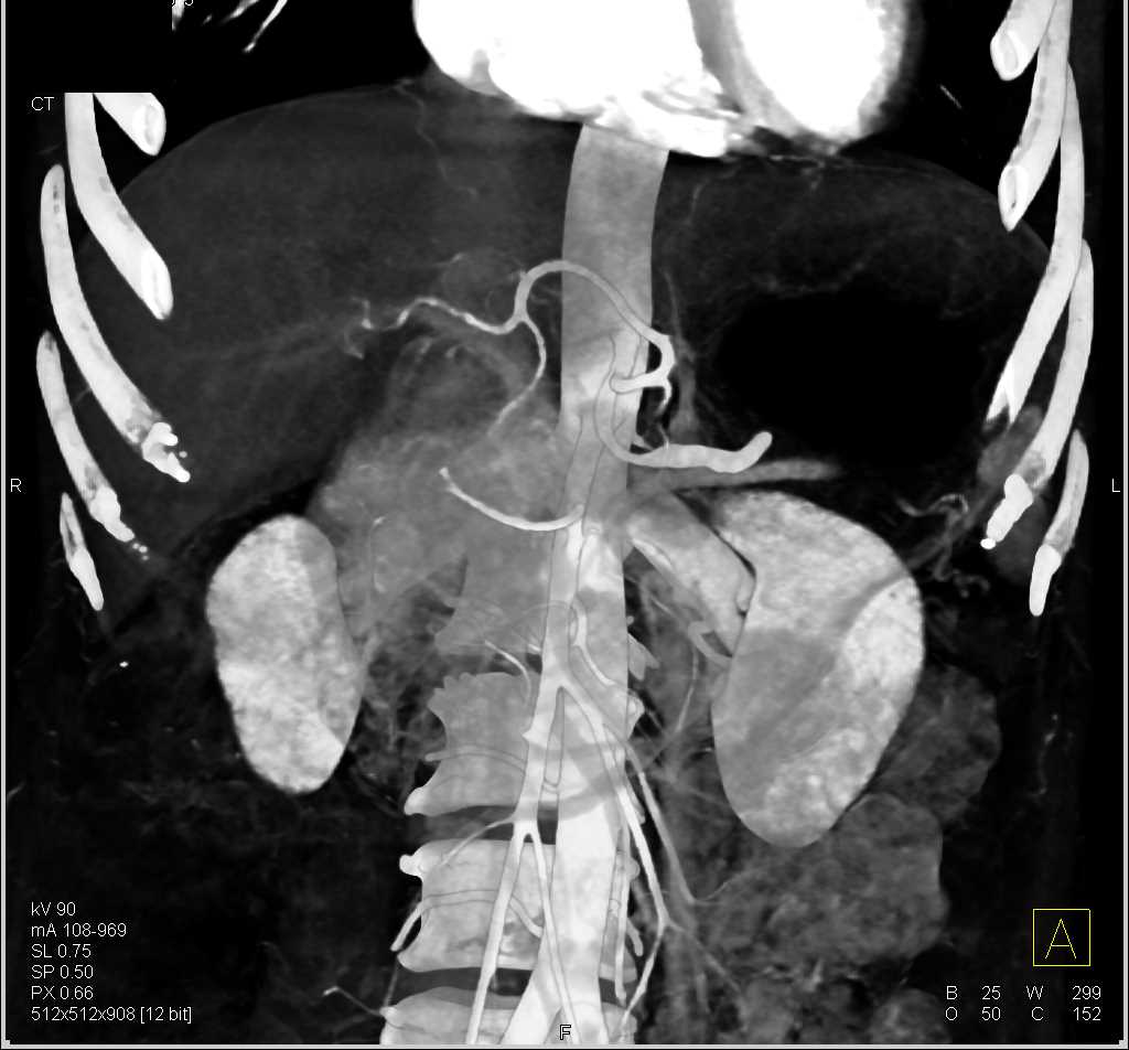 Adenocarcinoma Pancreas - CTisus CT Scan