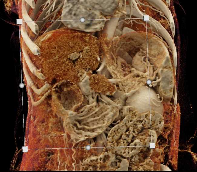 Adenocarcinoma Pancreas - CTisus CT Scan