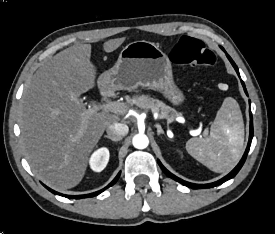 Adenocarcinoma Pancreas Invades and Encases the Celiac Artery - CTisus CT Scan