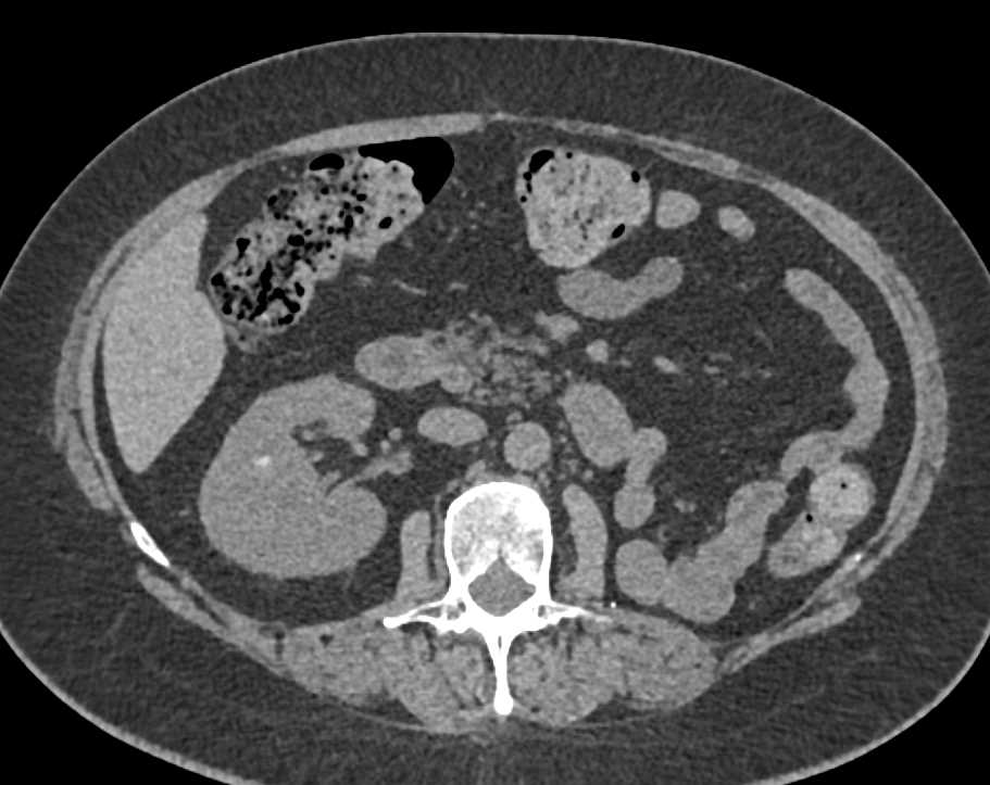 Metastatic Renal Cell Carcinoma to the Pancreas - CTisus CT Scan