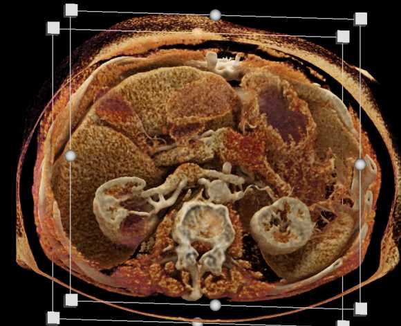 Pancreas Adenocarcinoma - CTisus CT Scan