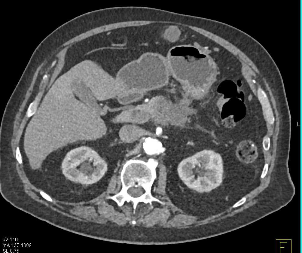 Pancreas Adenocarcinoma - CTisus CT Scan