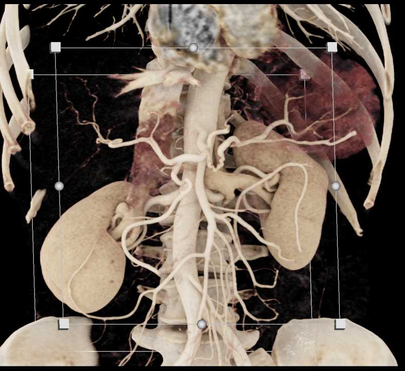 Pancreas Adenocarcinoma with Vessel Invasion - CTisus CT Scan