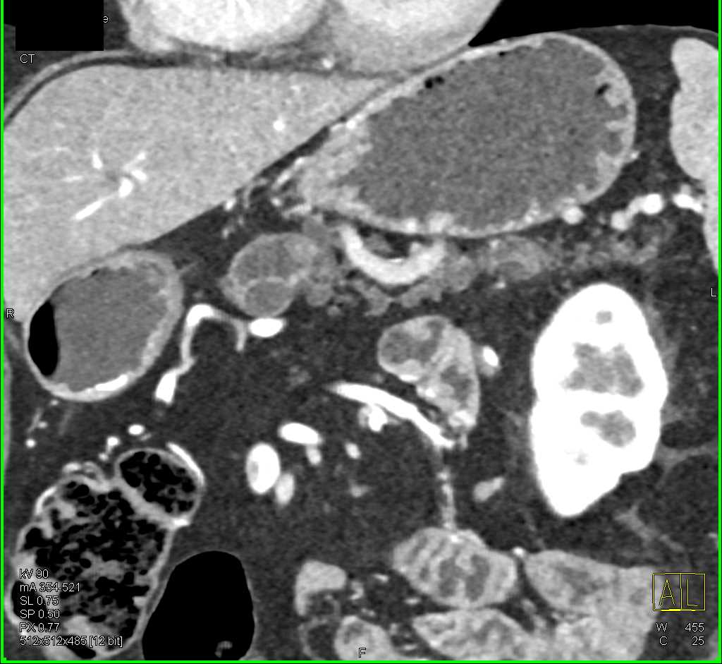 Mixed Type Intraductal Papillary Mucinous Neoplasm (IPMN) - CTisus CT Scan
