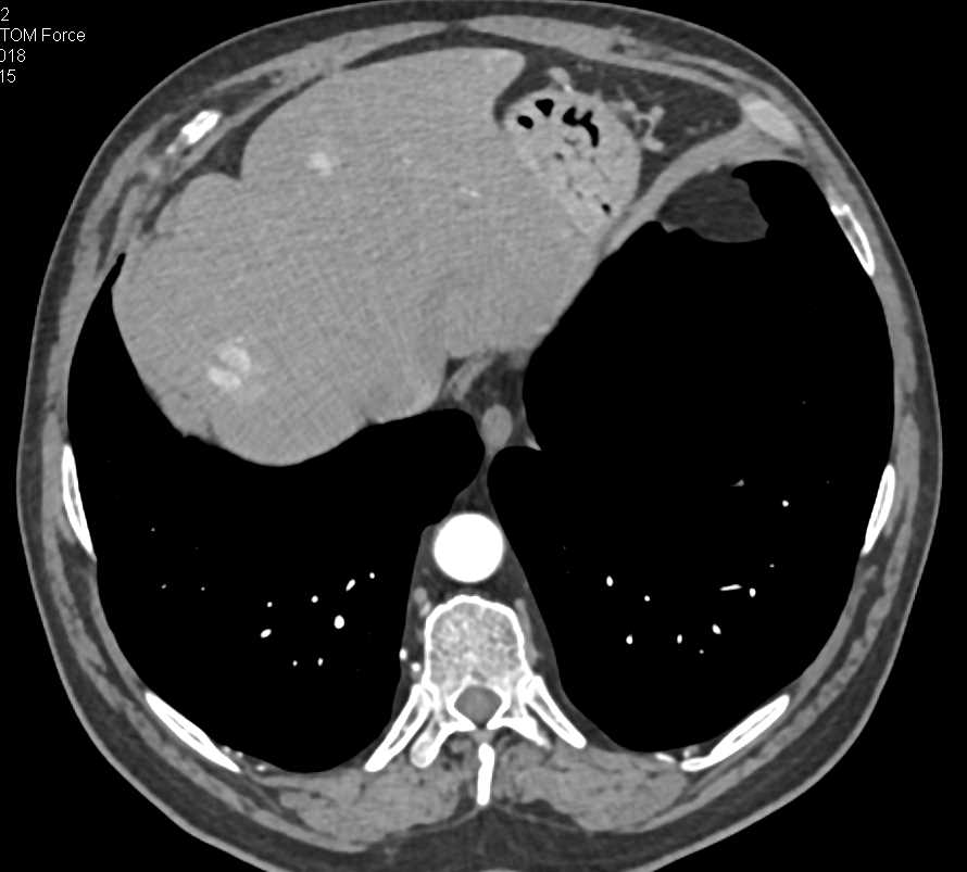 Subtle Neuroendocrine Tumor Tail of Pancreas - CTisus CT Scan