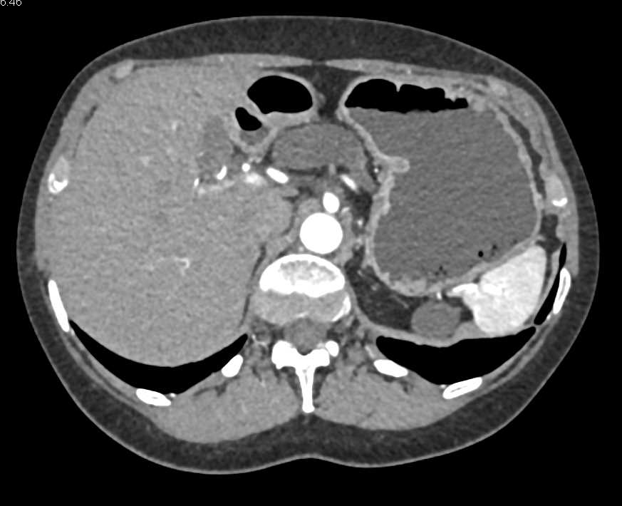 Mixed Type IPMN - CTisus CT Scan