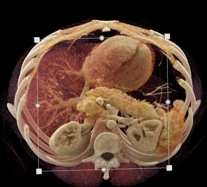 PNET in the Head of the Pancreas - CTisus CT Scan