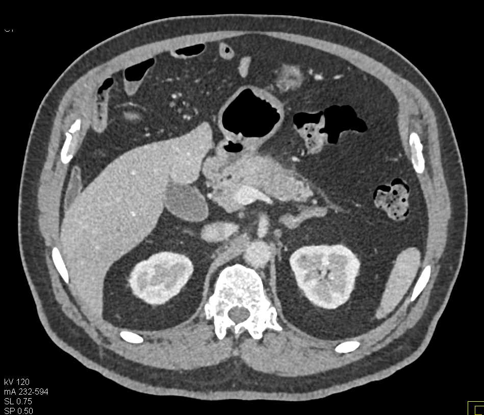Carcinoma Body of Pancreas with Dilated Pancreatic Duct - CTisus CT Scan