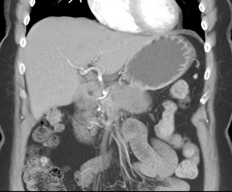 Pancreatic Adenocarcinoma - CTisus CT Scan
