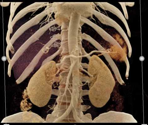 Pancreatic Adenocarcinoma - CTisus CT Scan