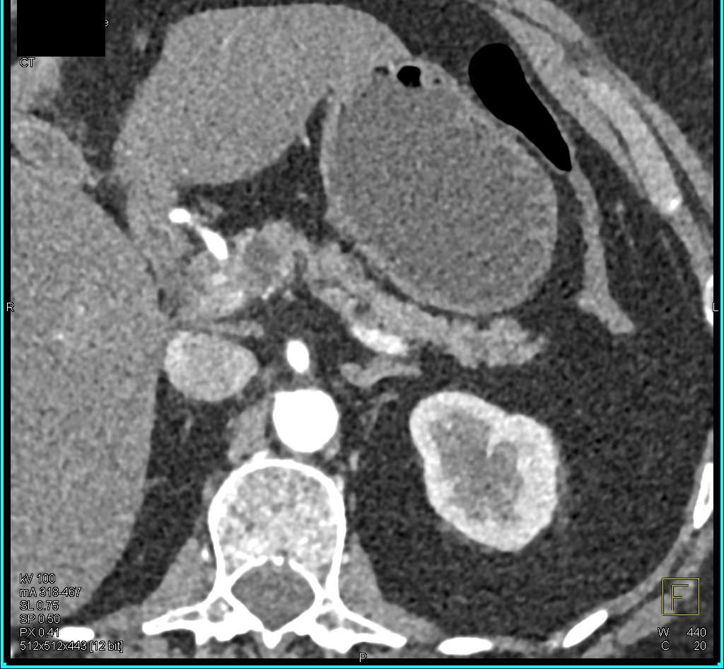 IPMN - CTisus CT Scan