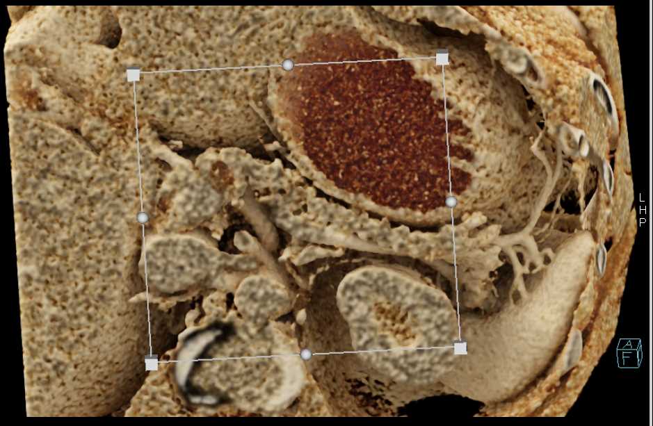 IPMN - CTisus CT Scan