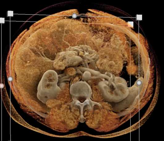 Cinematic Rendering of the Pancreas - CTisus CT Scan