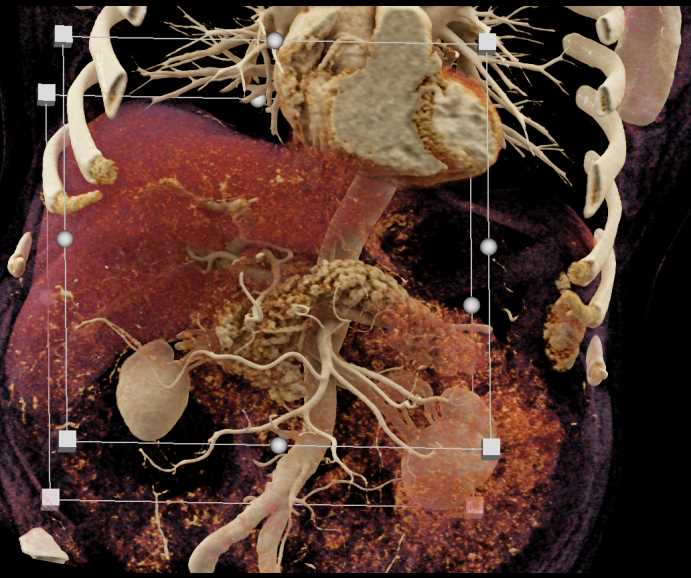 Cinematic Rendering of the Pancreas - CTisus CT Scan