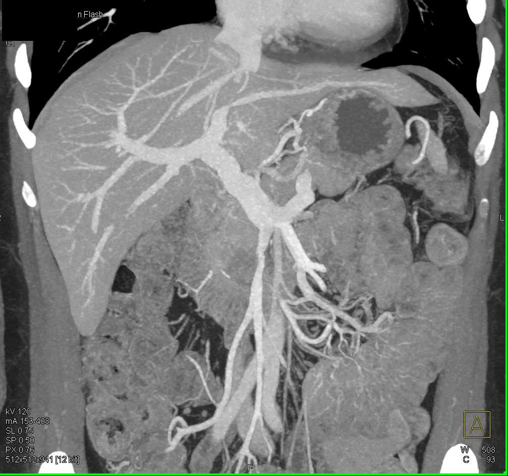 Adenocarcinoma of the Head of the Pancreas - CTisus CT Scan