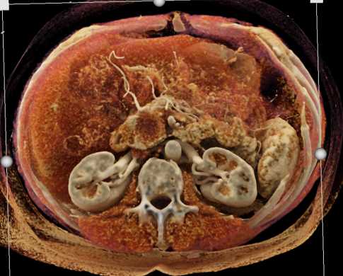Adenocarcinoma of the Head of the Pancreas - CTisus CT Scan