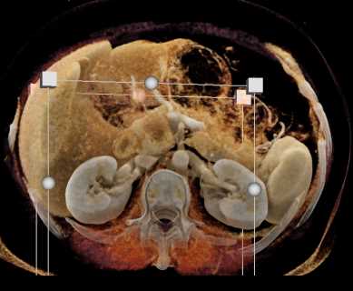 Adenocarcinoma of the Head of the Pancreas - CTisus CT Scan
