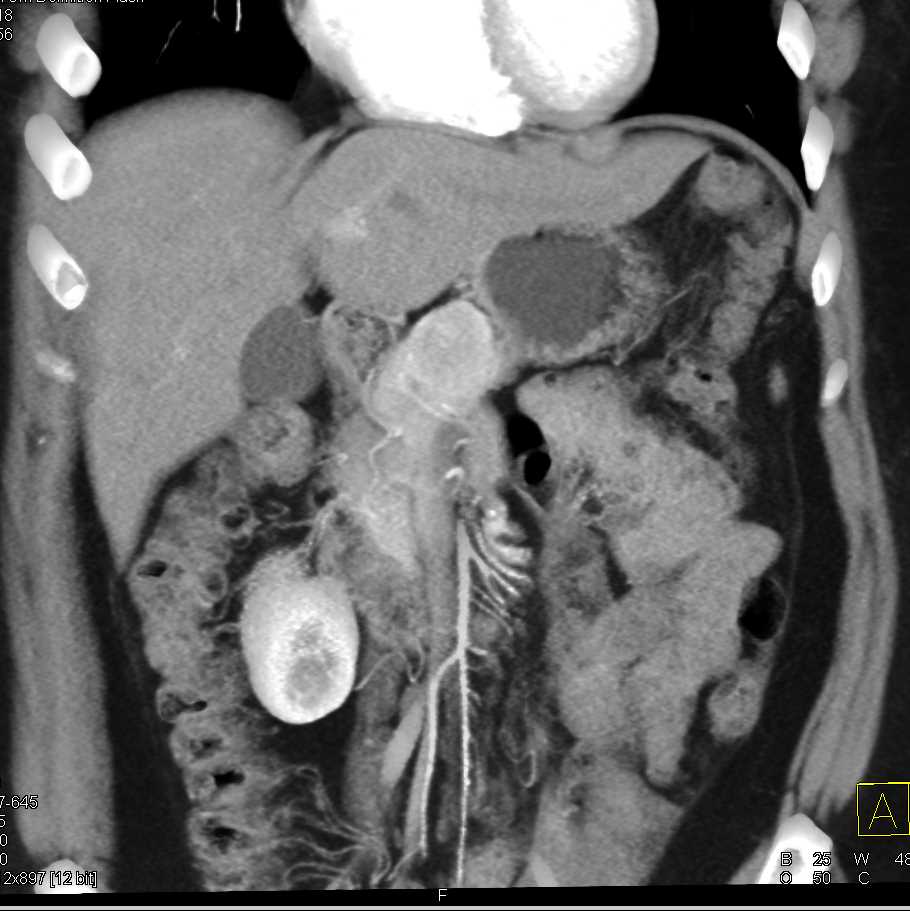 Neuroendocrine Tumor Body of Pancreas - CTisus CT Scan