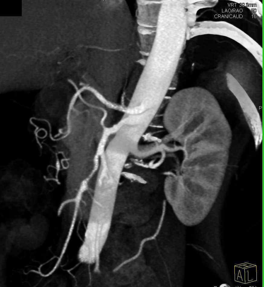 Neuroendocrine Tumor Body of Pancreas - CTisus CT Scan