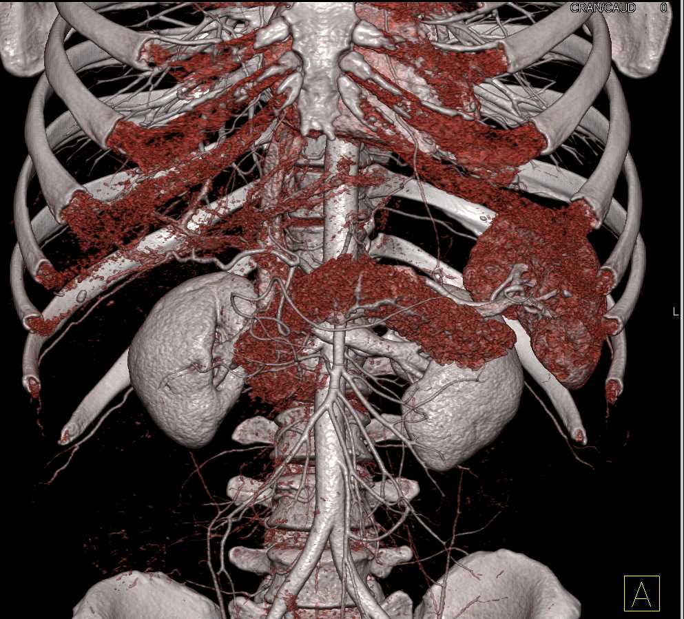 Neuroendocrine Tumor Body of Pancreas - CTisus CT Scan