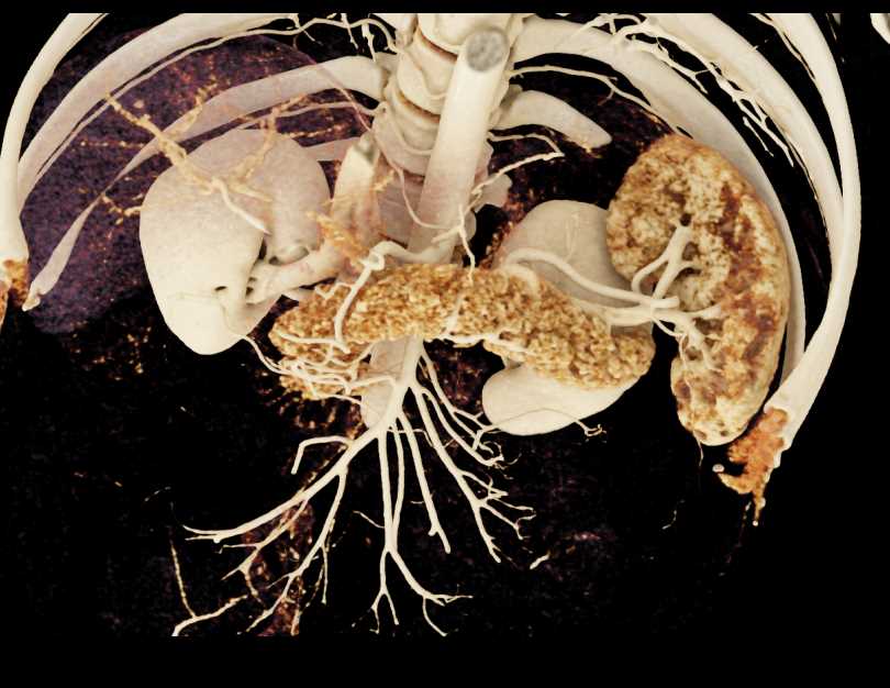 Subtle Neuroendocrine Tumor Body of Pancreas - CTisus CT Scan