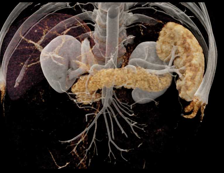 Subtle Neuroendocrine Tumor Body of Pancreas - CTisus CT Scan