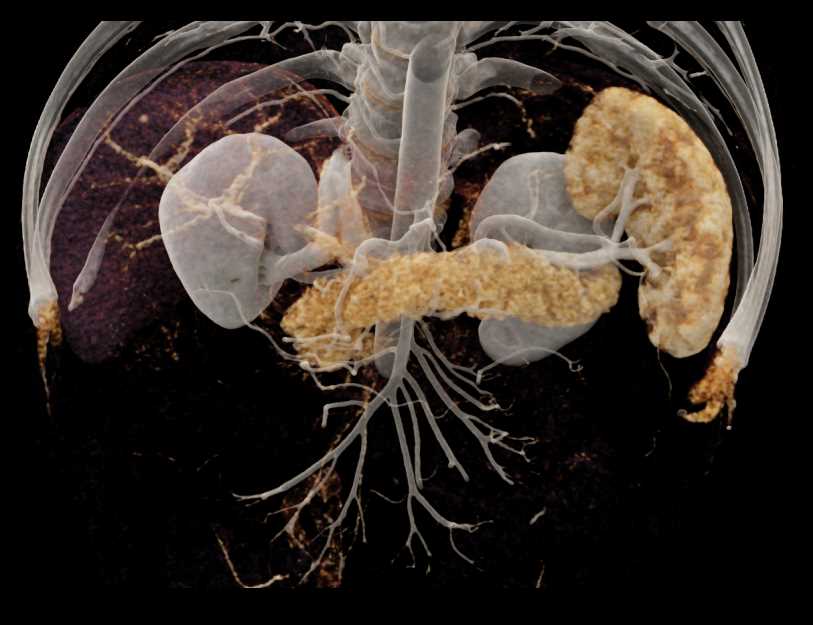 CTisus CT Scanning | Various Cinematic Renderings