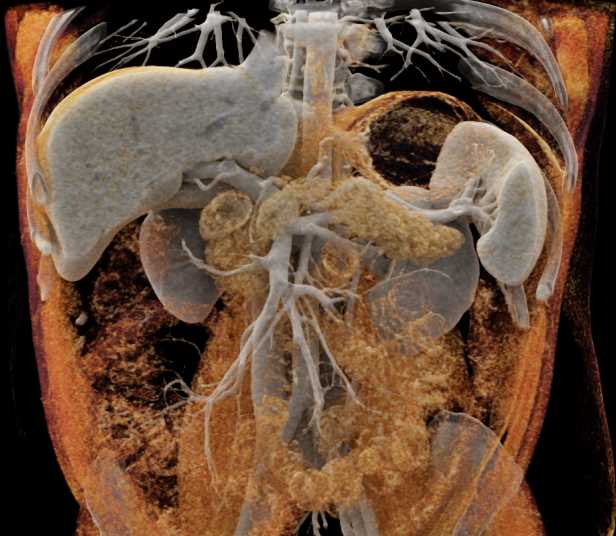Various Cinematic Renderings - CTisus CT Scan