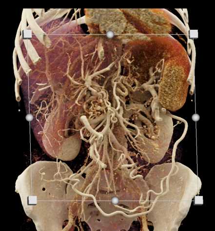 Pancreatic Cancer with Extensive Collaterals - CTisus CT Scan