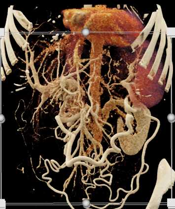Pancreatic Cancer with Extensive Collaterals - CTisus CT Scan