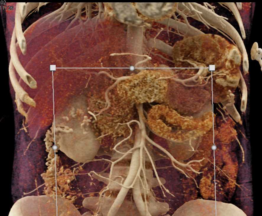 Mass Pushes on Tail of Pancreas - CTisus CT Scan
