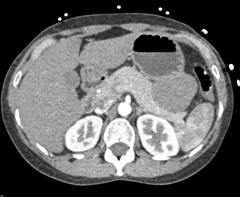 Mass Pushes on Tail of Pancreas was Ganglioneuroma - CTisus CT Scan