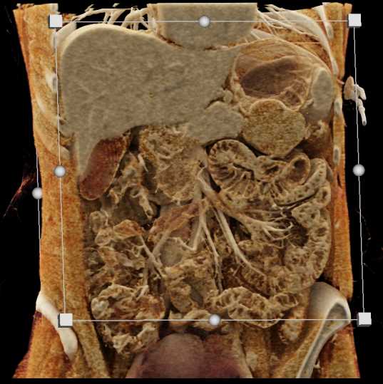 Mass Pushes on Tail of Pancreas was Ganglioneuroma - CTisus CT Scan