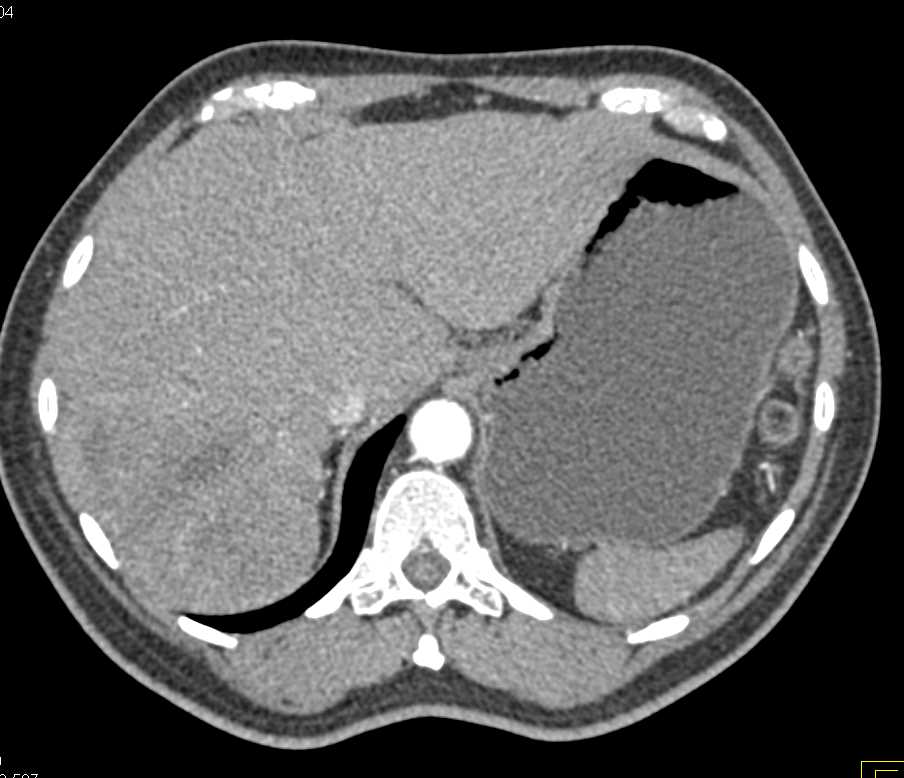 CTisus CT Scanning | Neuroendocrine Tumor Pancreas