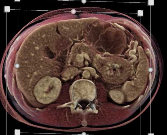 CTisus CT Scanning | PNET Tail of the Pancreas