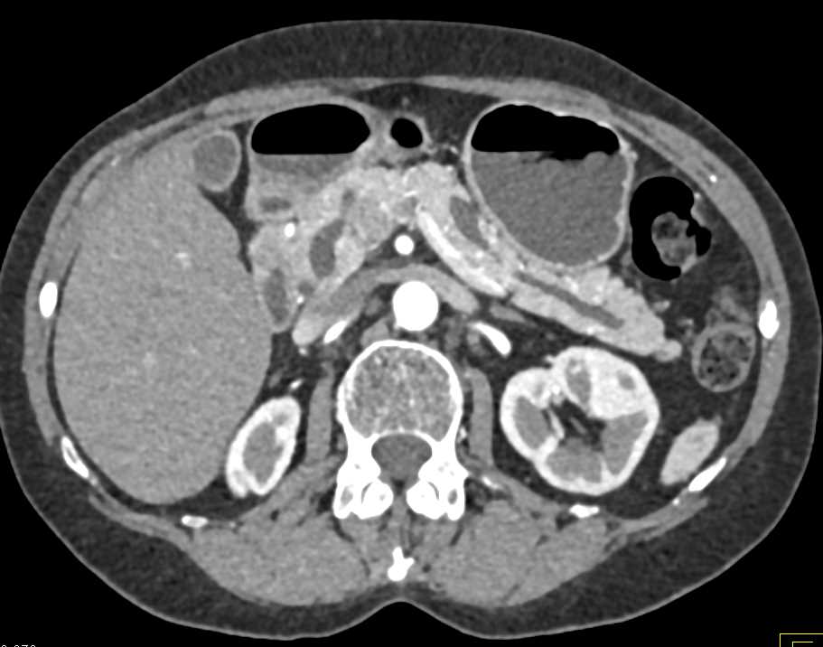 Mixed Type Intraductal Papillary Mucinous Neoplasm (IPMN) - CTisus CT Scan
