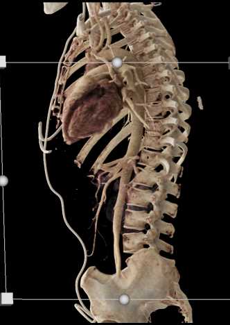 Intraductal Papillary Mucinous Neoplasm (IPMN) Pancreas - CTisus CT Scan