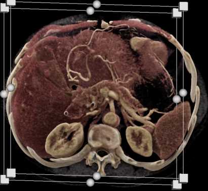 Neuroendocrine Tumor Head of Pancreas - CTisus CT Scan