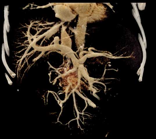 Neuroendocrine Tumor Head of Pancreas with CR - CTisus CT Scan
