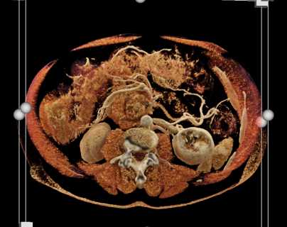 Adenocarcinoma Pancreas - CTisus CT Scan