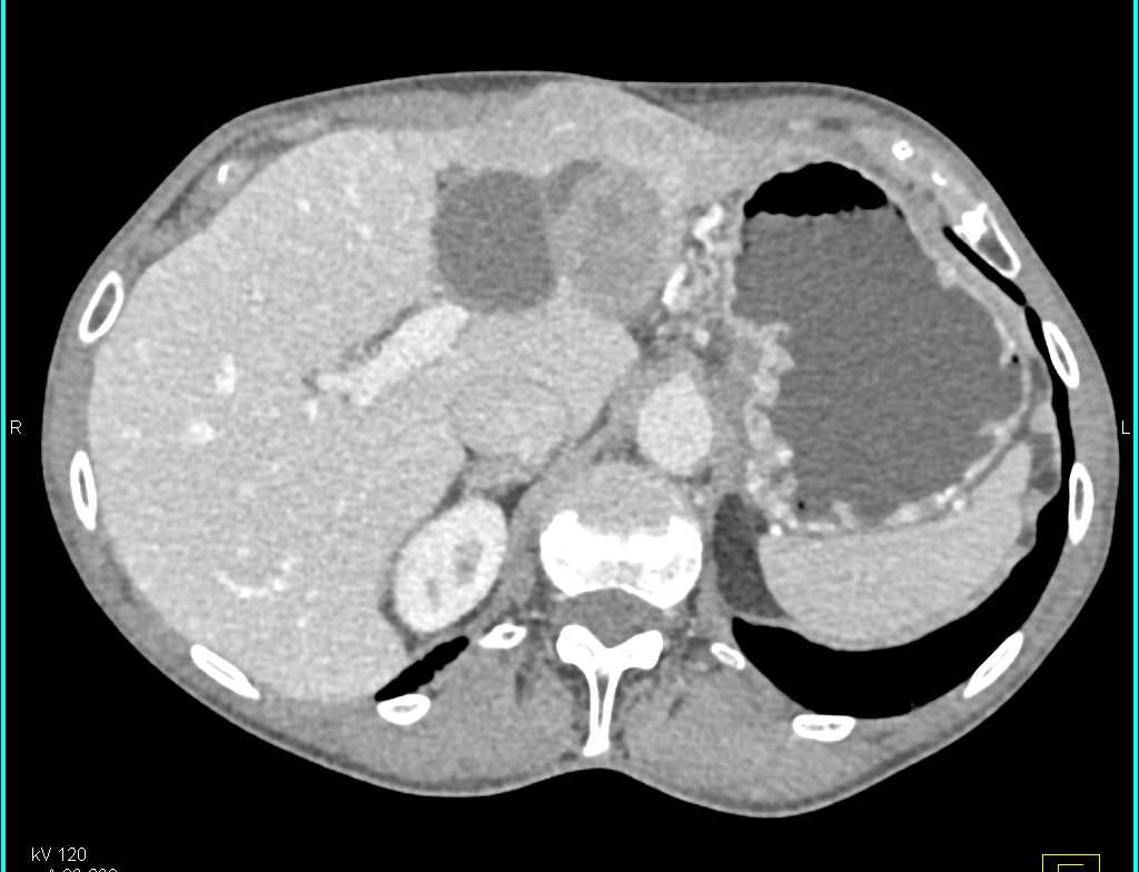 Solid and Papillary Epithelial Neoplasm (SPEN) Tumor - CTisus CT Scan