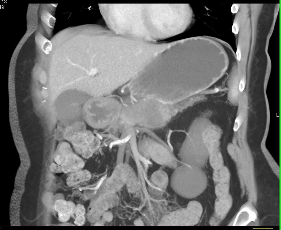 Pancreatic Cancer Arises from an Intraductal Papillary Mucinous Neoplasm (IPMN) - CTisus CT Scan