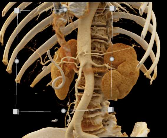 Pancreas Cancer with Common Bile Duct (CBD) Stent - CTisus CT Scan