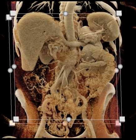 Pancreas Cancer with Dilated Pancreatic Duct - CTisus CT Scan