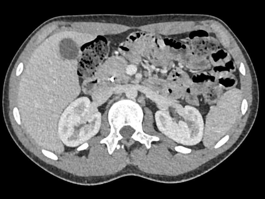 Subtle Pancreatic Cancer with Common Bile Duct (CBD) Stent - CTisus CT Scan