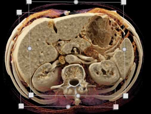 Carcinoma of the Pancreas - CTisus CT Scan