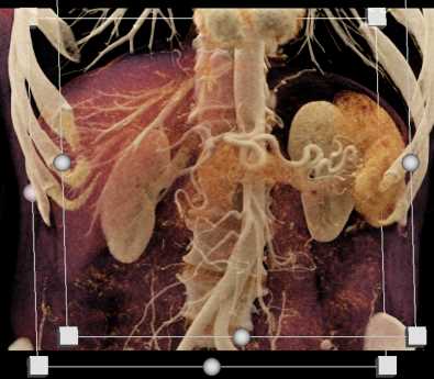 Pancreatic Adenocarcinoma - CTisus CT Scan